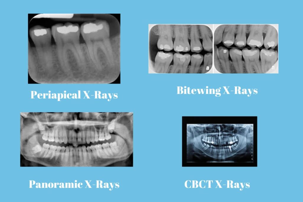 Can an X-ray Show Tooth Nerve Damage?