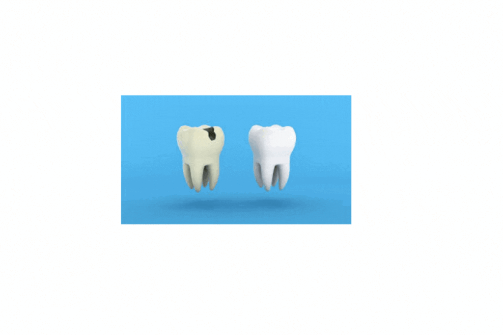 Tooth Decay | Secondary Occlusal Trauma