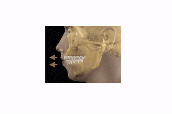 What is Primary Occlusal Trauma